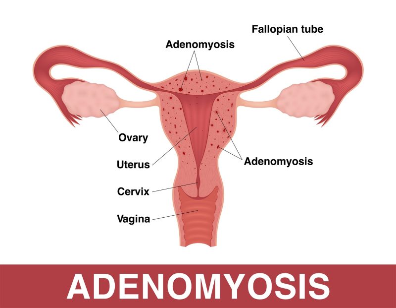 Adenomyosis uterus, bulky uterus with adenomyosis
